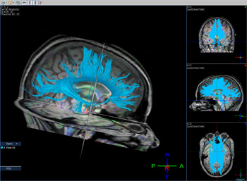 TI tractography shows white matter fibers (blue) found to be affected by heading.