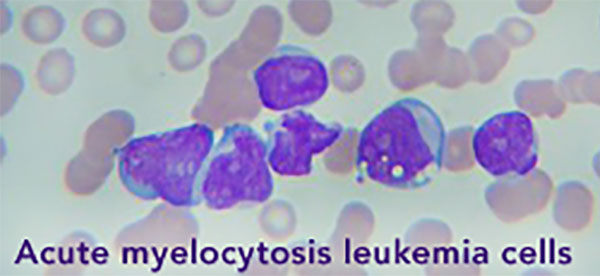 Gene Discovery Could Improve Treatment for Acute Myeloid Leukemia