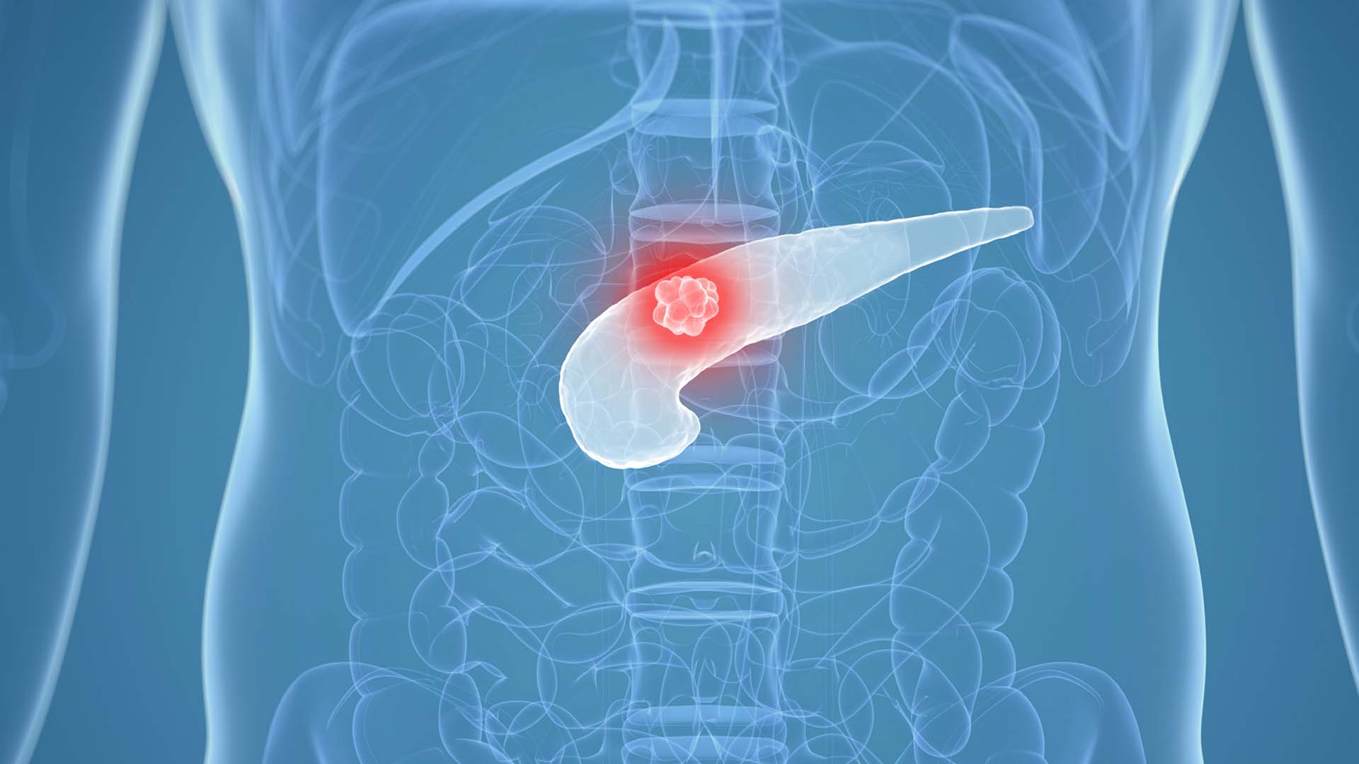 Novel Therapeutic Strategy Shows Promise Against Pancreatic Cancer