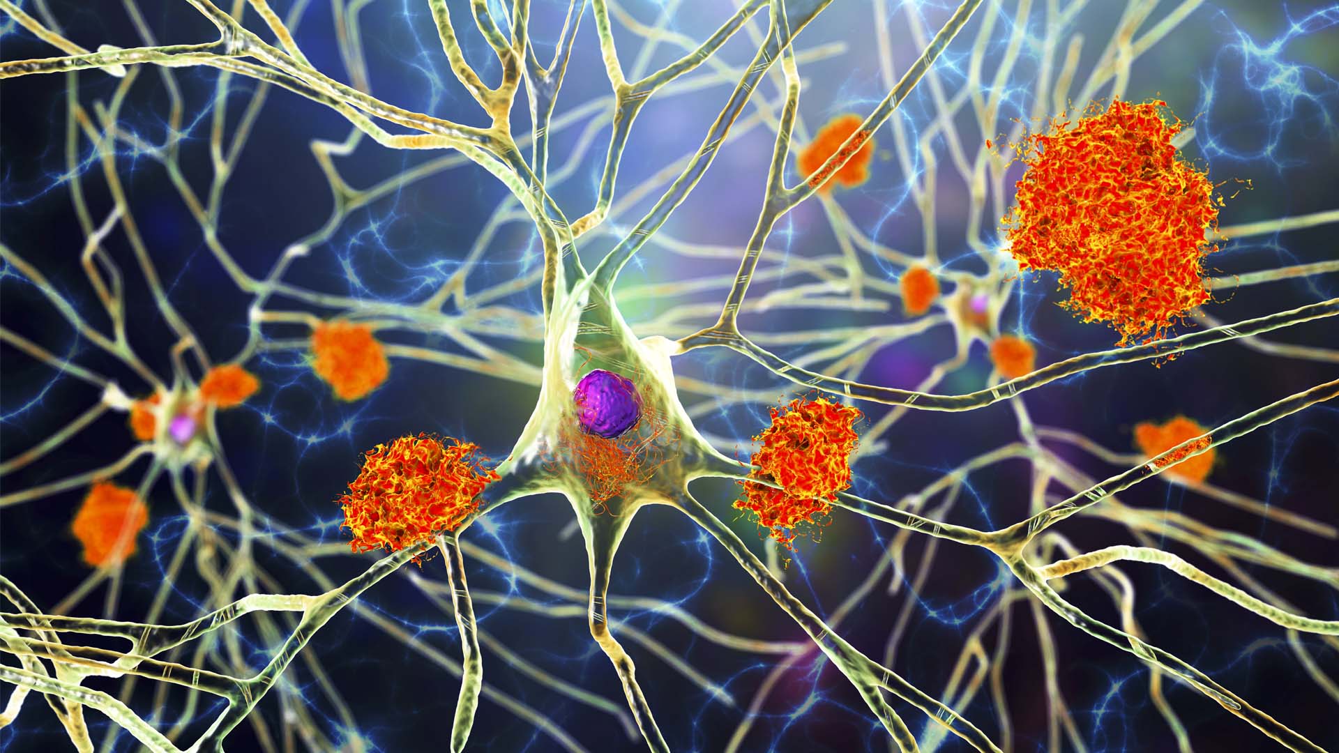 Memory Test Mirrors Brain Pathology Found in Alzheimer’s Trial