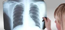 Major Funding Awarded to Improve Treatment of Drug-Resistant Tuberculosis and HIV Co-Infection