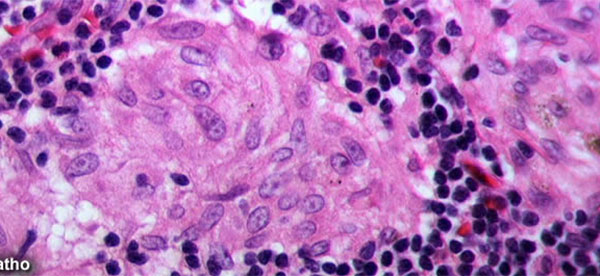 Study Examines Link Between HPV in the Mouth and Risk of Head and Neck Cancers