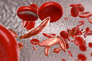 Targeting a Sickle-Cell Problem