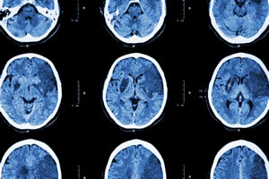 A Genetic Link Between Stroke and Depression