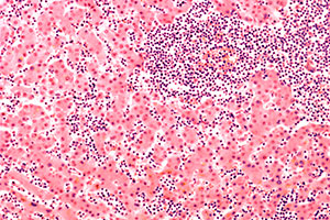 Finding the Root Causes of Blood Cancers