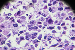 Bone Cancers Without Biopsies