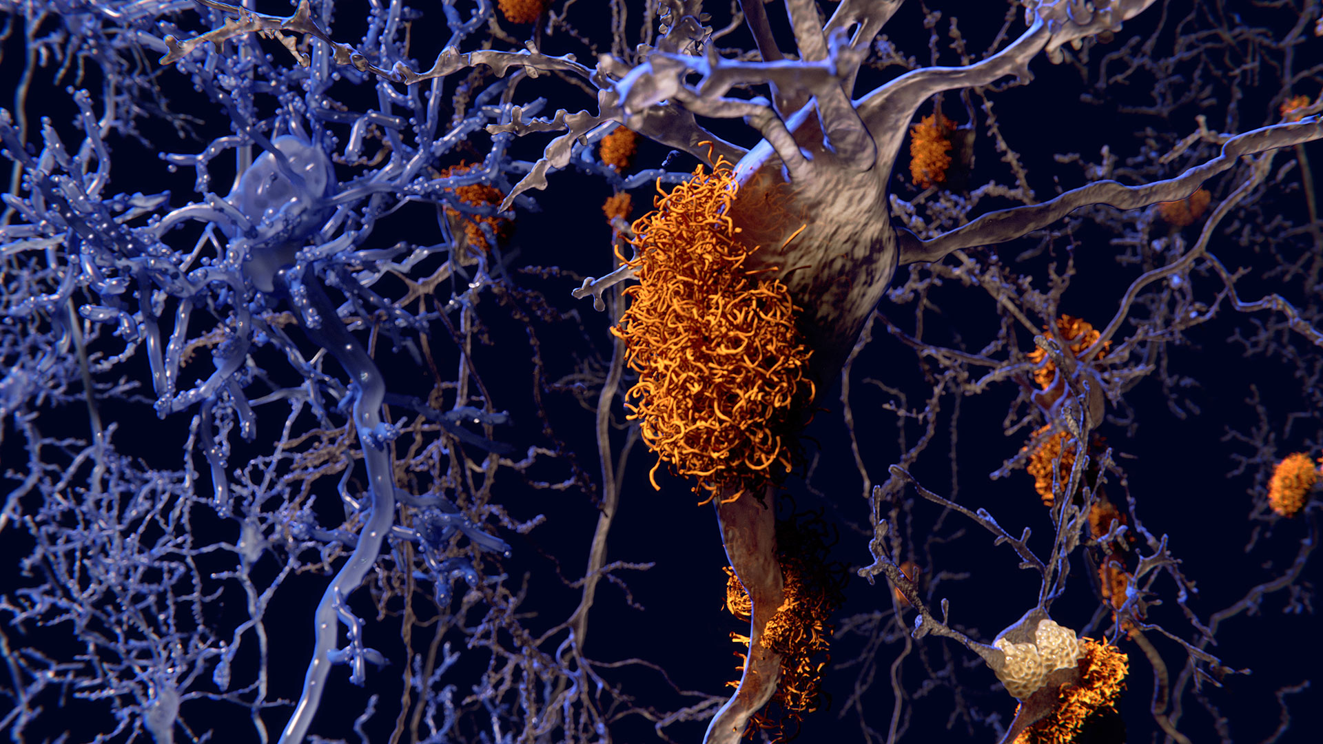 Bladder Cancer Therapy May Reduce Alzheimer’s Risk