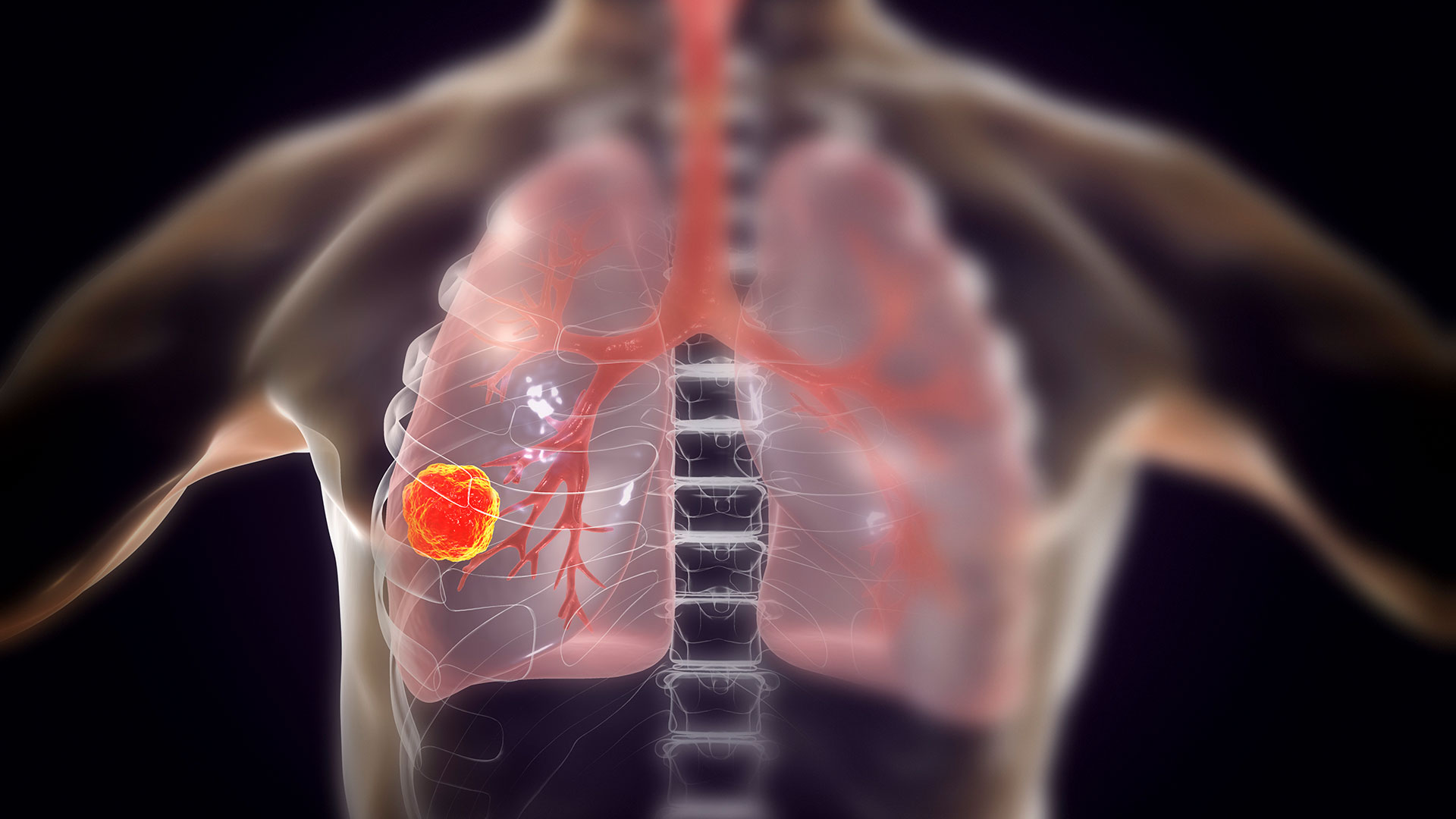 Overcoming Lung Cancer’s Resistance to Immune Attack