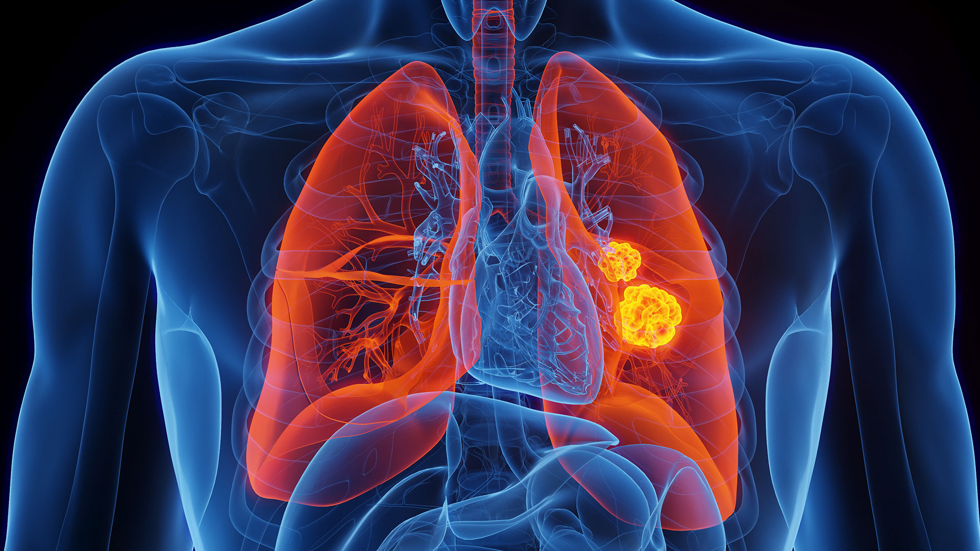 Surgery Can Help Patients with “Oligometastatic” Lung Cancer Live Longer