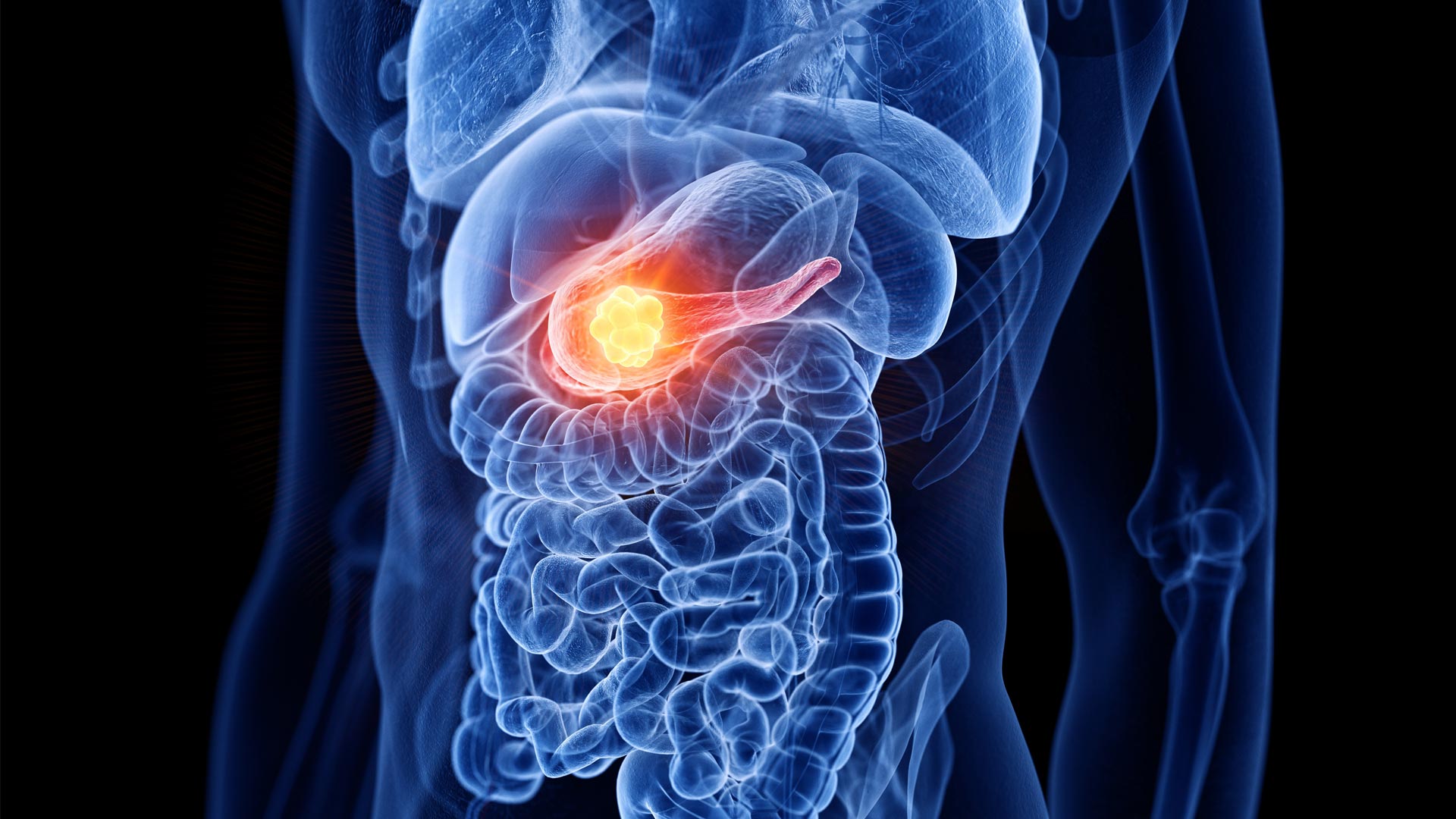 A New Approach to Treating Pancreatic Cancer