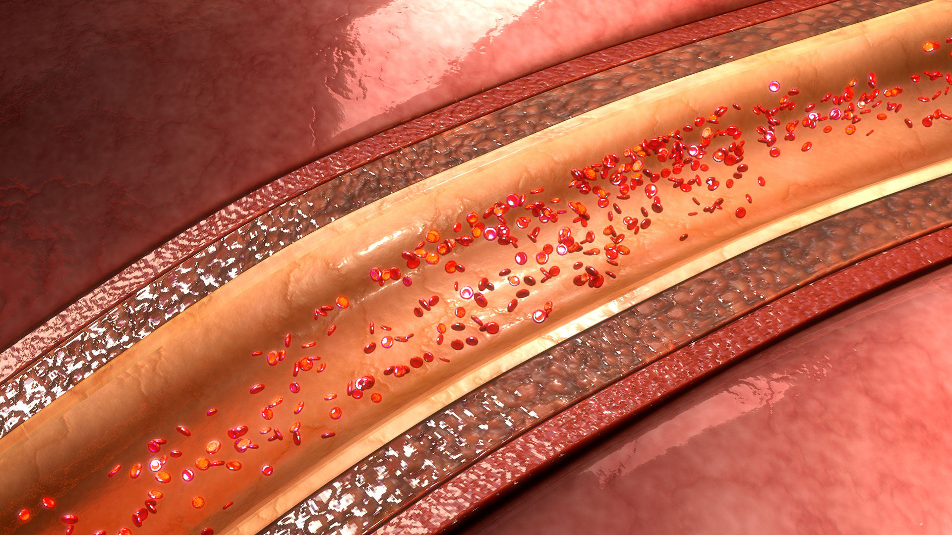 Investigating Arterial Calcium Buildup in Chronic Kidney Disease