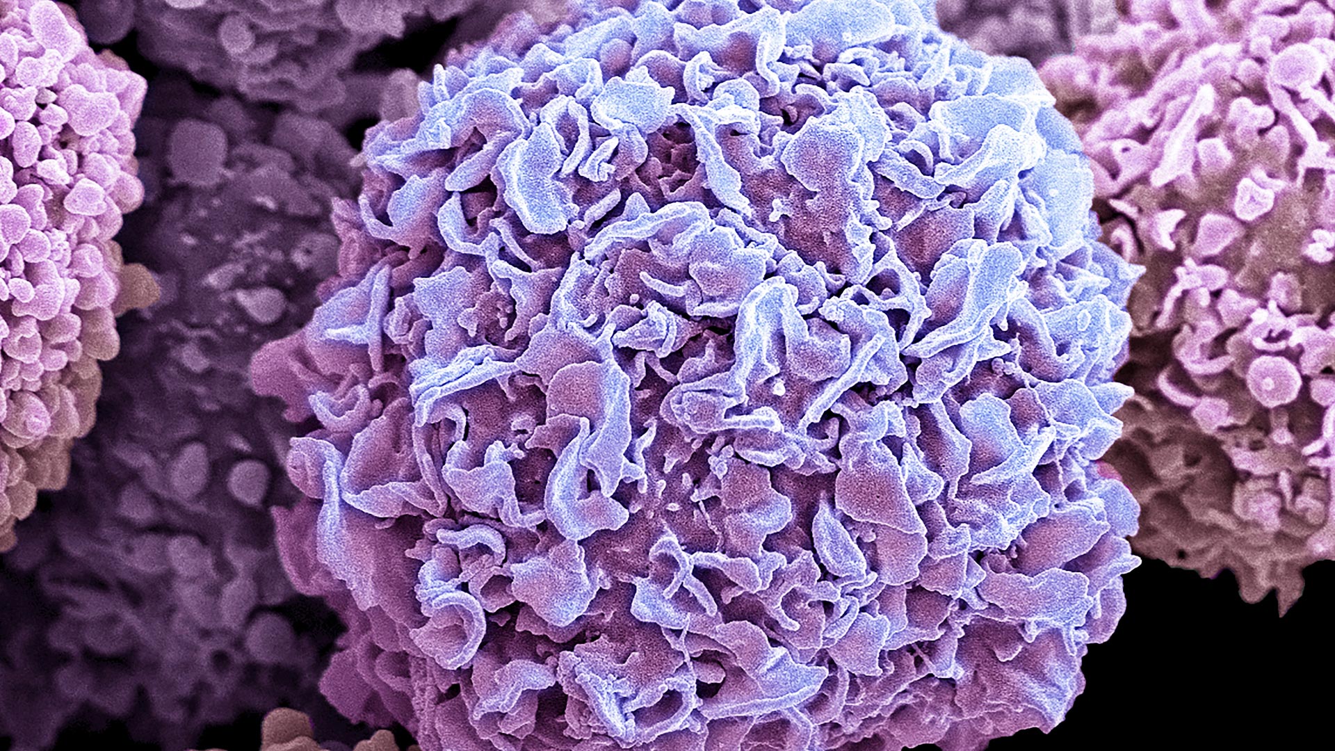 Investigating a Mutation that Leads to Breast Cancer