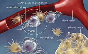 Metastasis requires the presence of three cells in the same microanatomic site: a tumor cell that produces the protein Mena; a macrophage (a cell that guides tumor cells to blood vessels); and a blood-vessel endothelial cell. The presence of three such cells in contact with each other is called a tumor microenvironment of metastasis, or TMEM, which is depicted within the circle in this illustration.